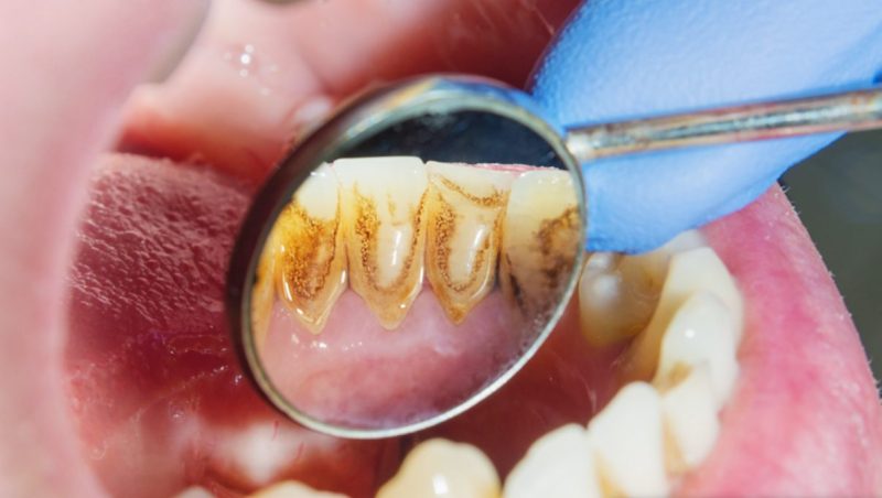 tác hại của việc lấy cao răng