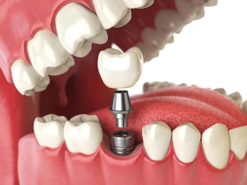 chi phí trồng răng implant
