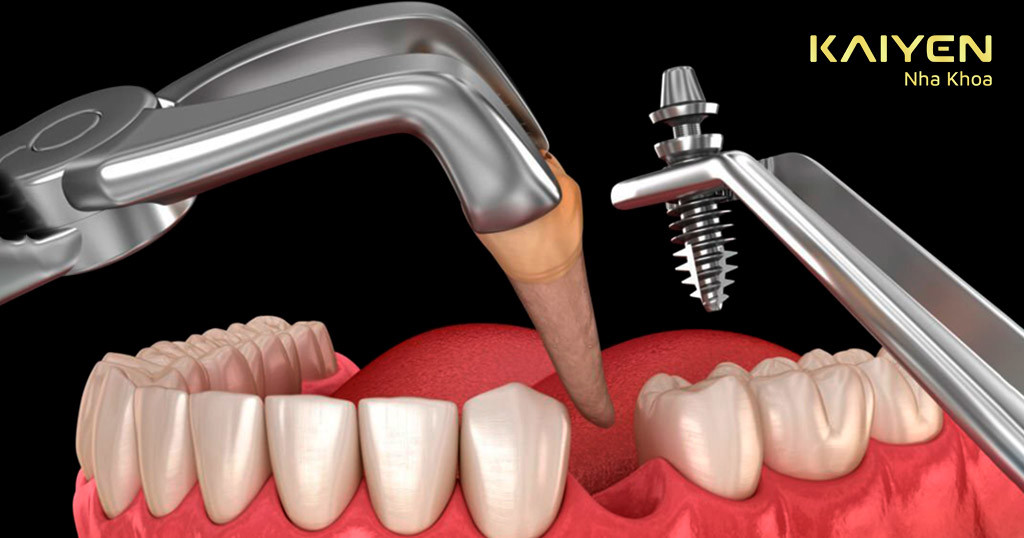 Trồng răng Implant bao lâu thì lành? Bao lâu thì ăn uống bình thường?