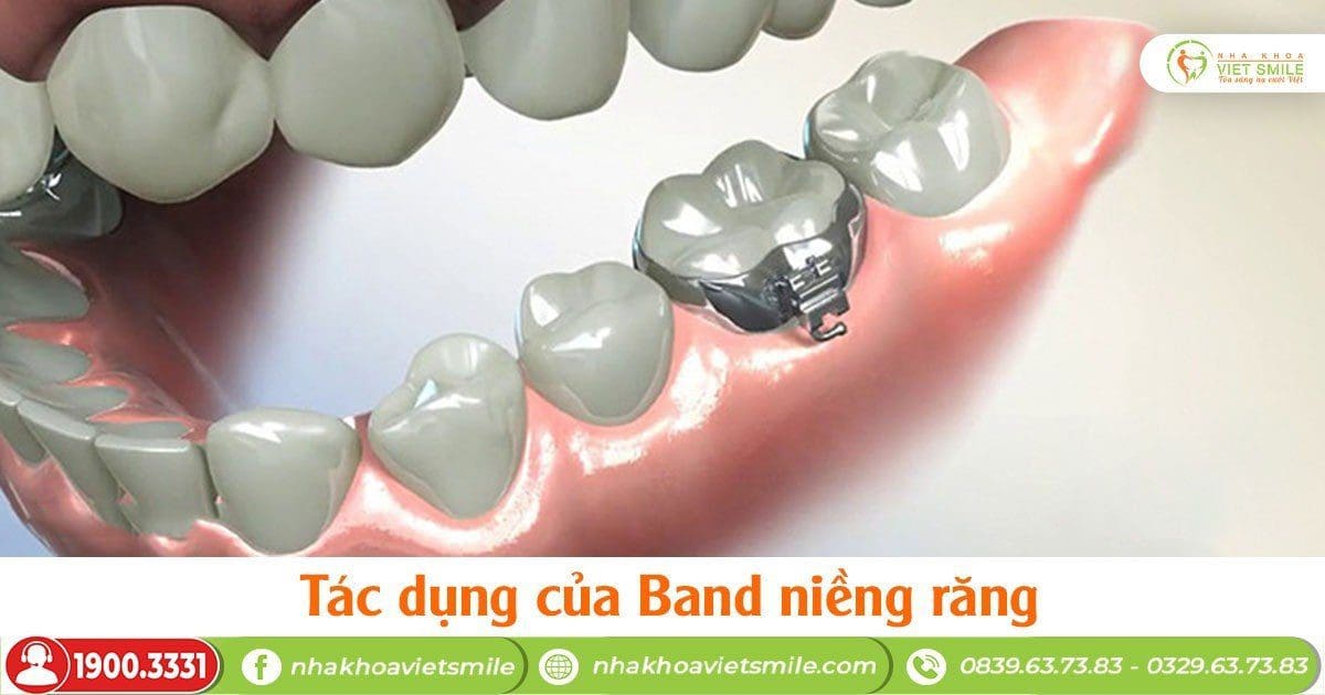 Band niềng răng là gì?#