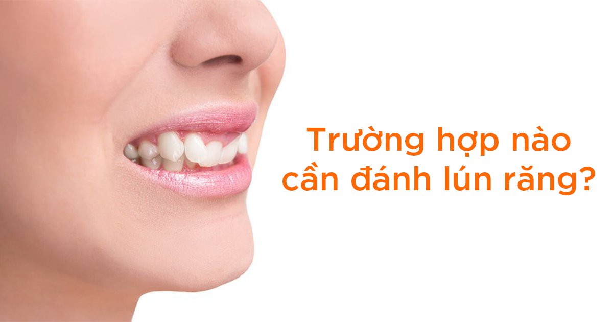 Đánh lún răng là gì? Tại sao cần đánh lún răng khi niềng răng?
