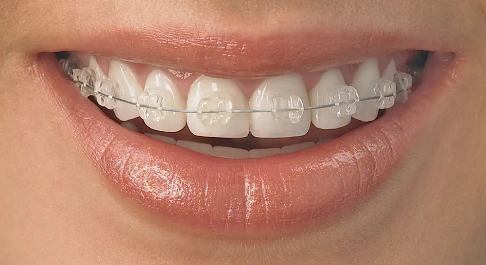 Dây cung niềng răng là gì? Tìm hiểu kích thước, công dụng và phân loại của nó tại Elite Dental