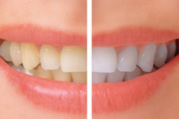 Giá làm trắng răng phụ thuộc vào yếu tố nào?