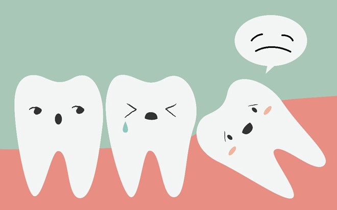 Mọc răng khôn Dấu hiệu, đau nhức và cách xử lý