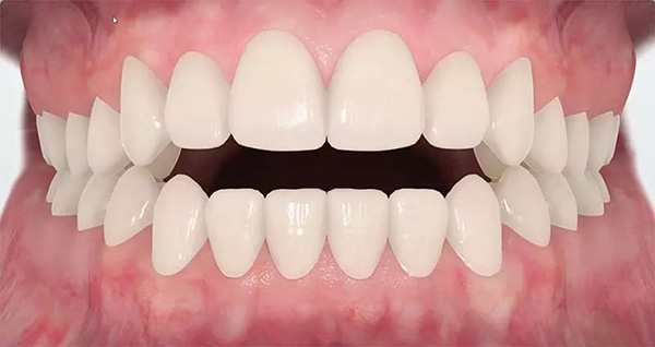 Nâng khớp cắn trong niềng răng là gì? Tác dụng và có đau không?