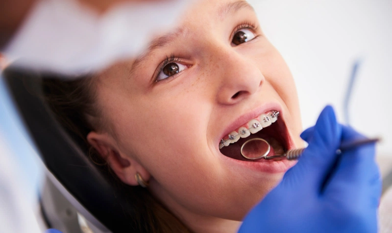 Niềng răng cho trẻ em Phương pháp, giá cả và địa điểm tốt nhất