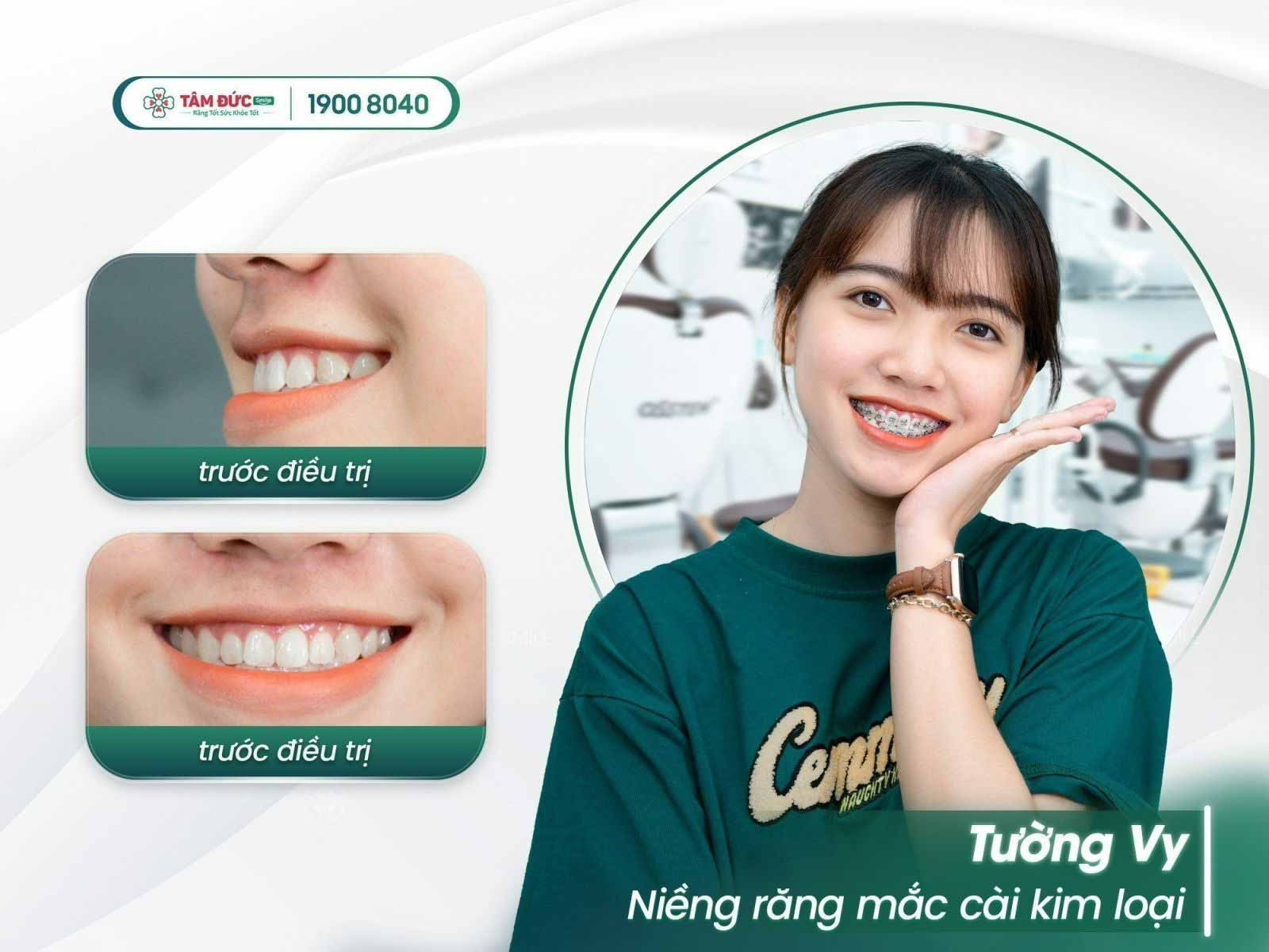 Niềng răng mắc cài kim loại và 7 điều nhất định phải biết