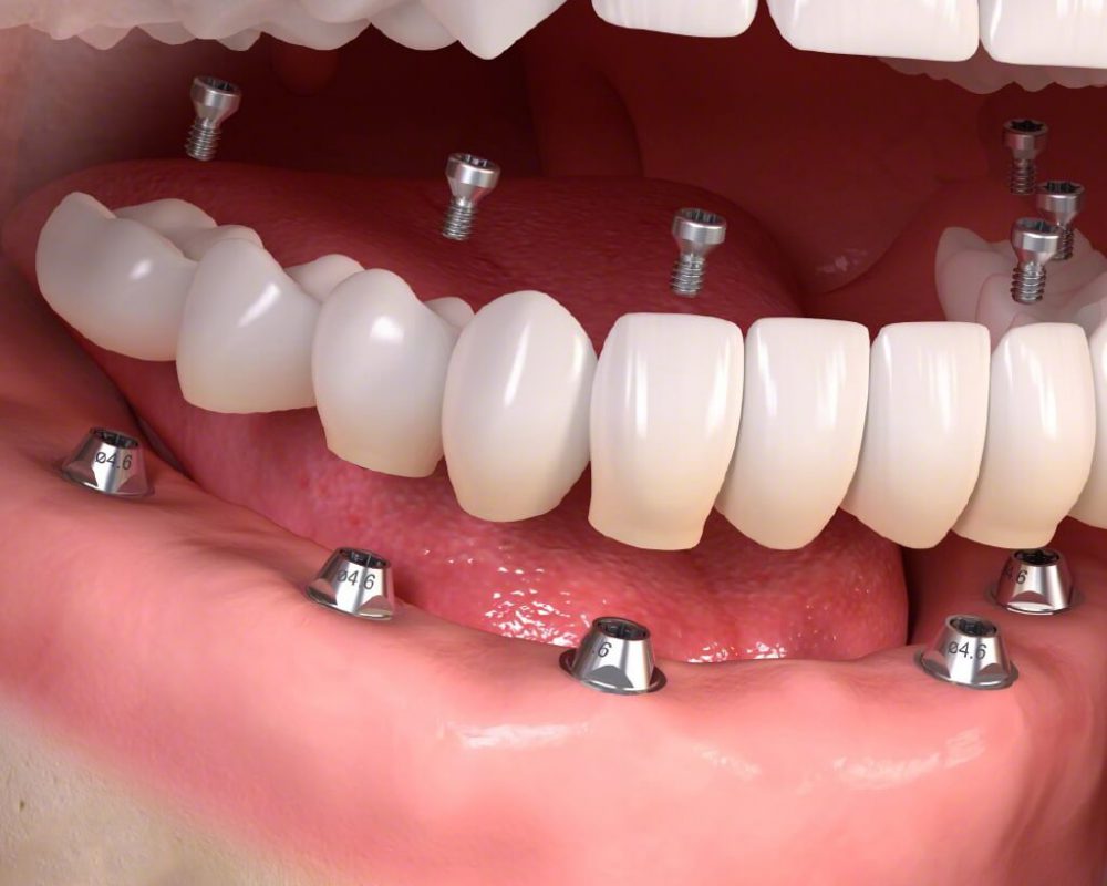 Phục hình răng là gì? Các phương pháp phục hình răng hiện nay