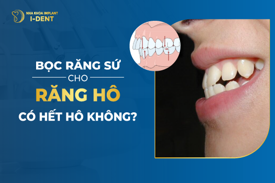 Răng hô vẩu Nguyên nhân là gì? Giải pháp nào dành cho răng vẩu?