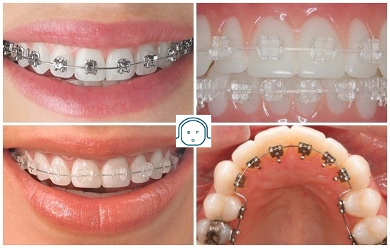 Răng xấu phải làm thế nào? Cách khắc phục để có hàm răng đẹp