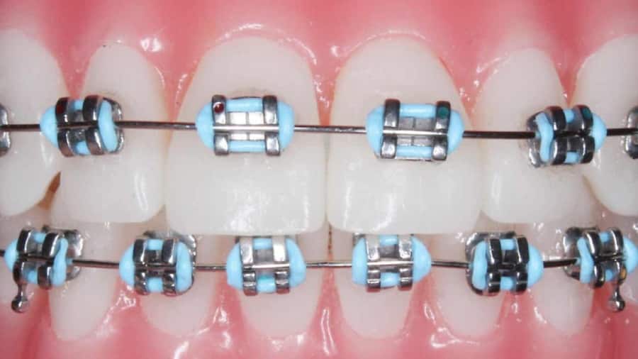 Sáp nha khoa niềng răng là gì?