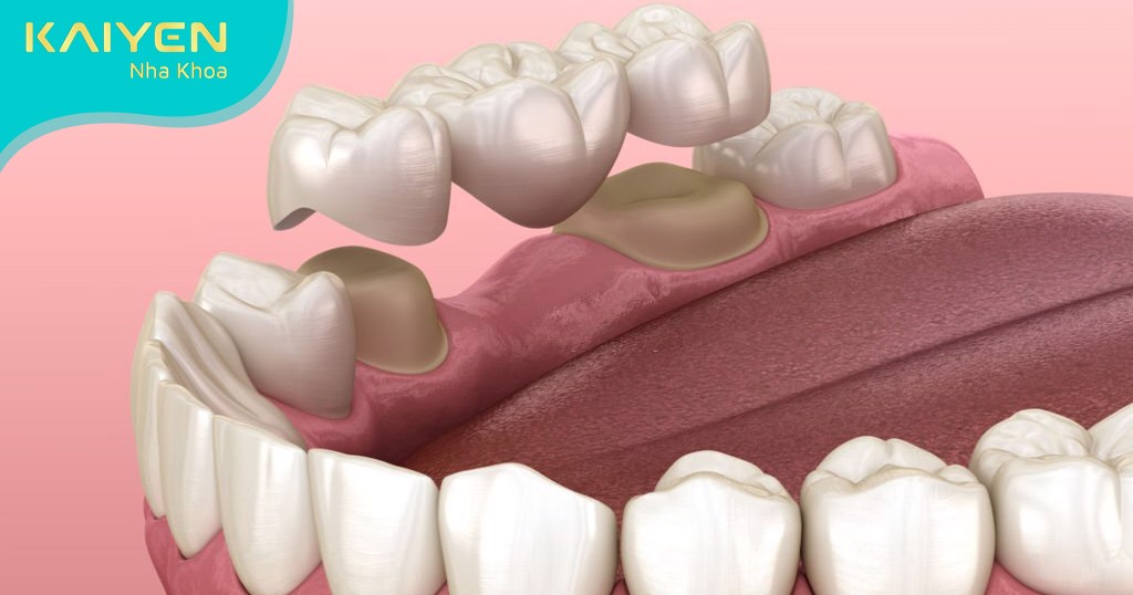 Tác hại của bọc răng sứ Những điều cần chú ý trước khi thực hiện