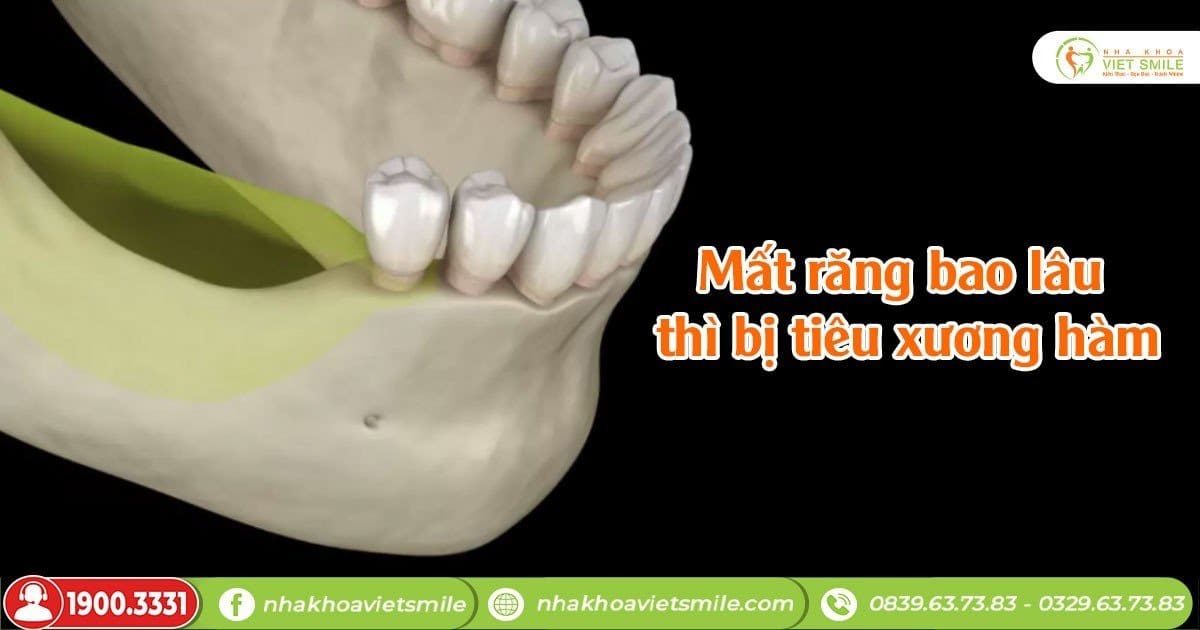 Tiêu xương hàm răng Nguyên nhân, tác hại và cách điều trị hiệu quả
