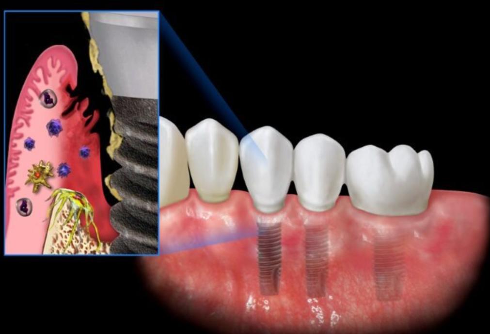 Trồng răng Implant có nguy hiểm không