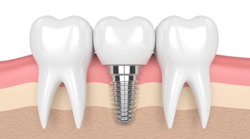 Trồng răng Implant có nguy hiểm không