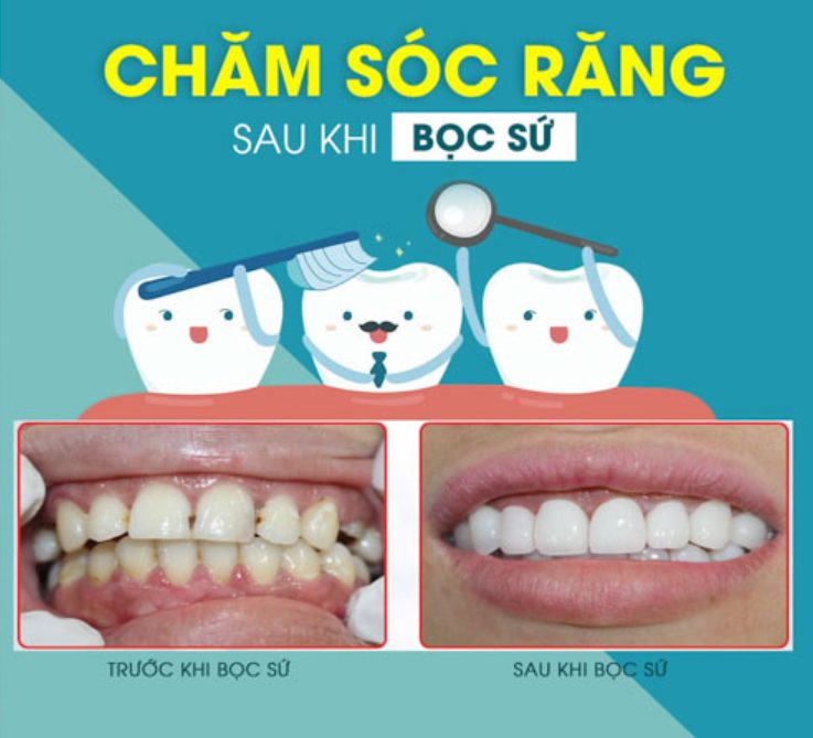 cách vệ sinh răng miệng sau khi bọc răng sứ