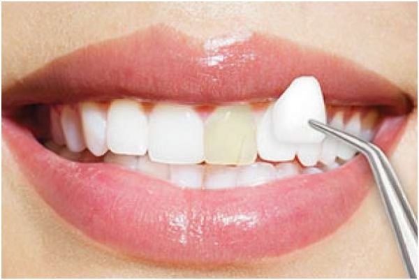 Bọc Răng Sứ: Giải Pháp Hoàn Hảo Hay Nguy Cơ Tiềm Ẩn?