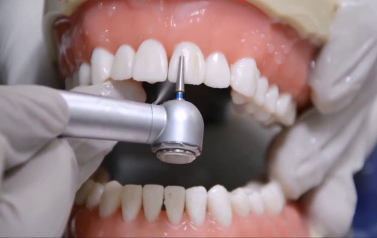 Mặt Dán Sứ Veneer Emax: Giải Pháp Thẩm Mỹ Răng Miệng Tại Nha Khoa Sài Gòn Mỹ Phước