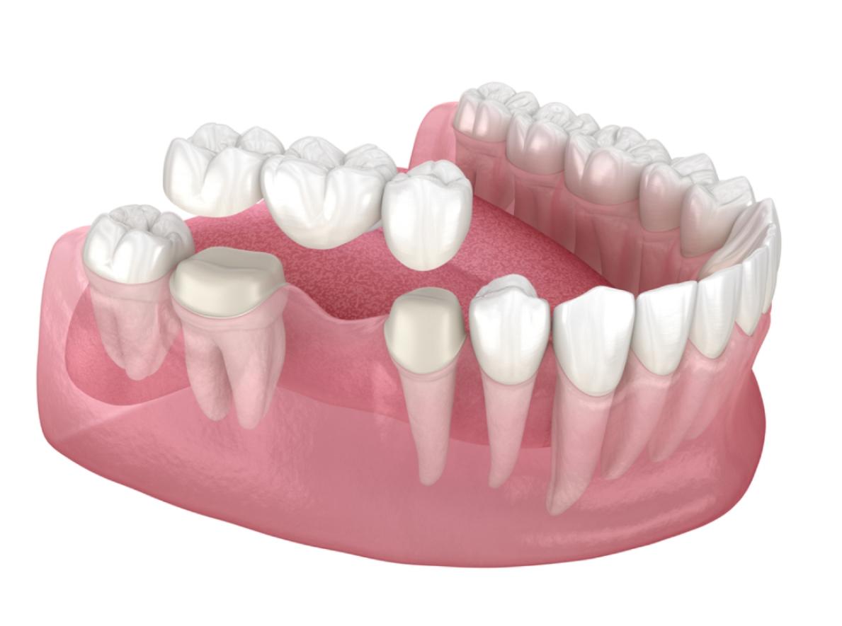 Phương pháp cầu răng sứ trồng răng vĩnh viễn