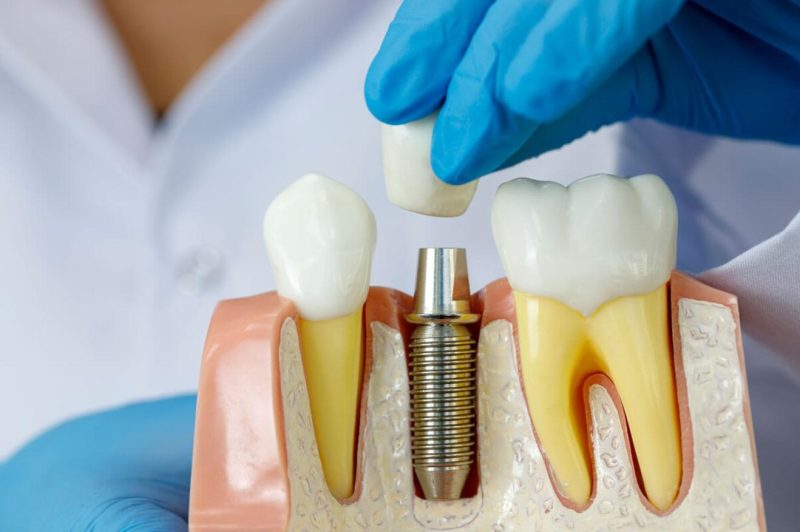 phương pháp trồng răng vĩnh viễn