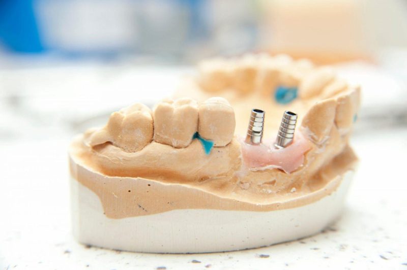 răng implant bị rớt