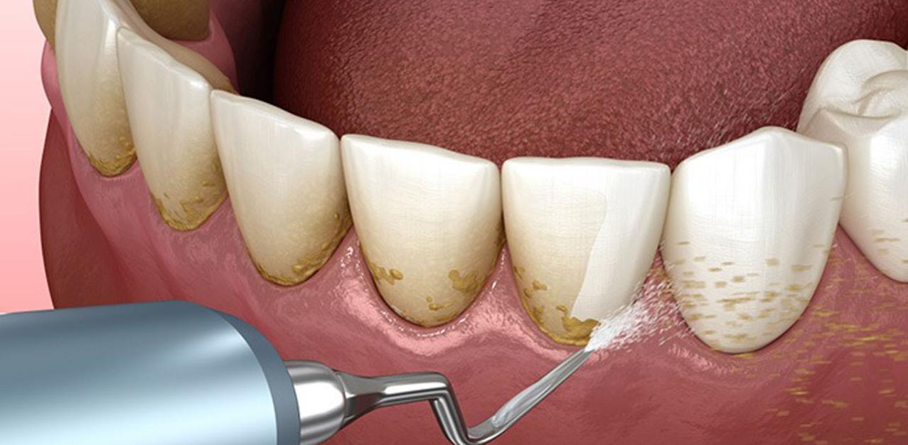 Dịch vụ cạo vôi răng tại nha khoa là một trong những cách loại bỏ cao răng đen hiệu quả