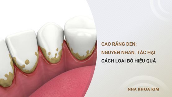 Cao Răng Đen - Mối Nguy Hiểm Gây Hại Răng Miệng Mà Bạn Phải Biết