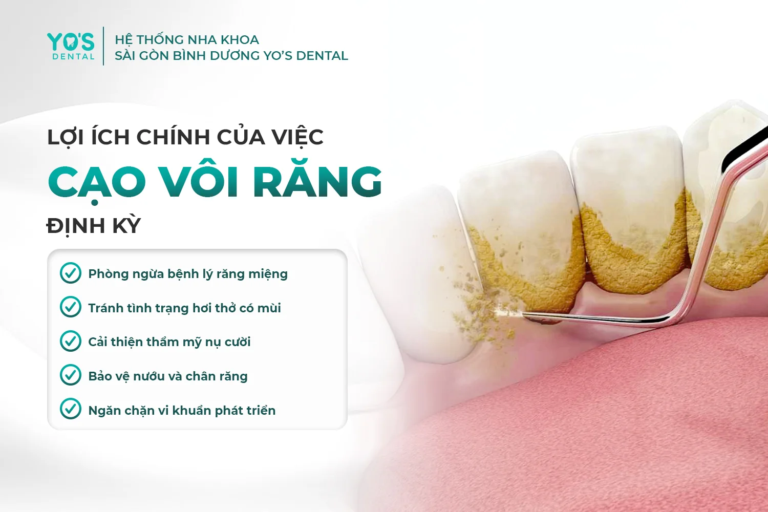 Cạo vôi răng có đau không? – Những điều cần biết để yên tâm hơn khi làm sạch răng