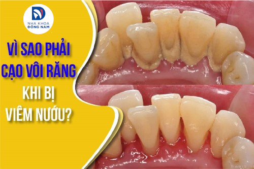 Cạo vôi răng có đau không? – Những điều cần biết để yên tâm hơn khi làm sạch răng