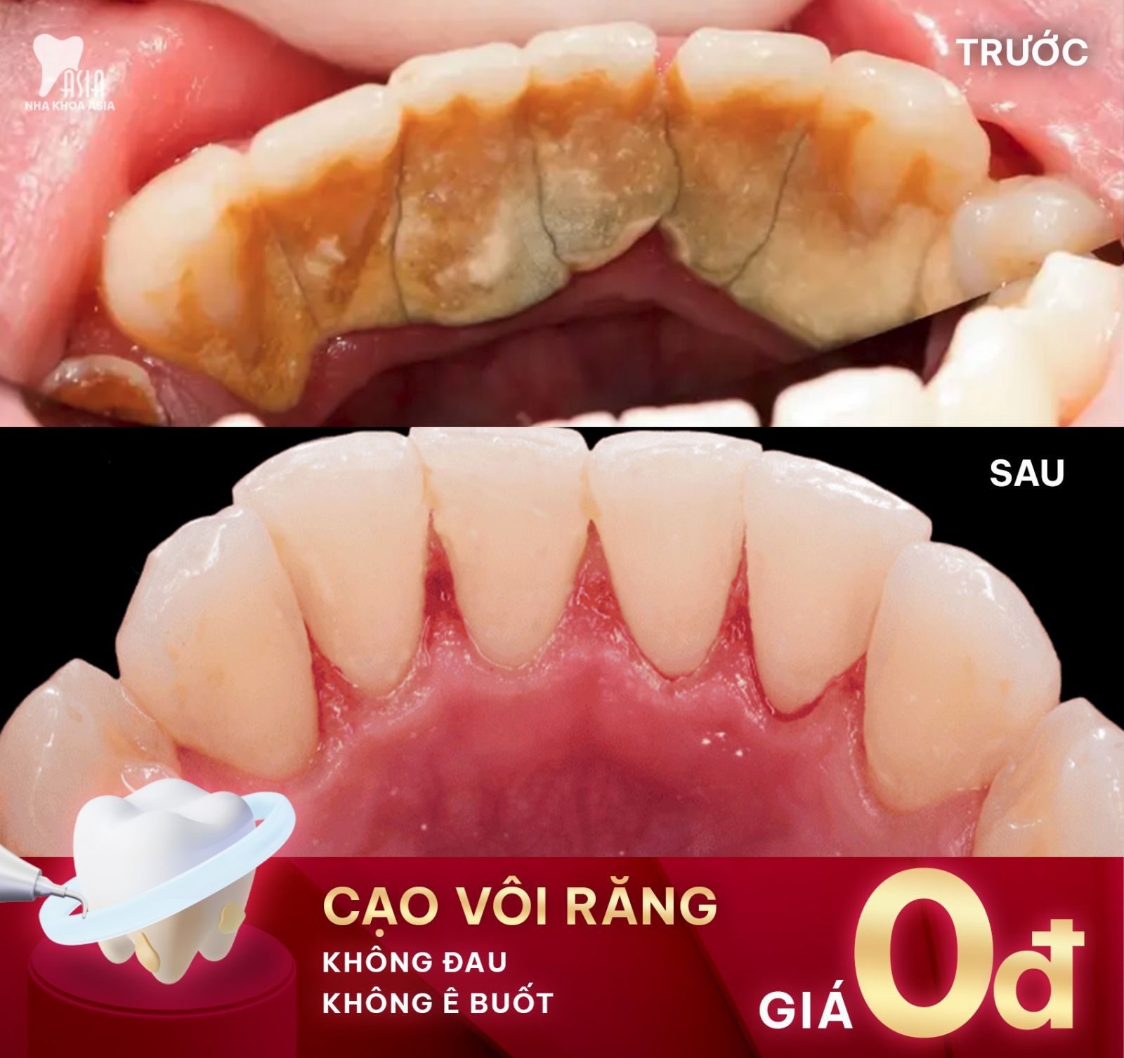 Cạo vôi răng có đau không? – Những điều cần biết để yên tâm hơn khi làm sạch răng