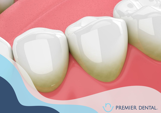 Cạo vôi răng là gì? Bí quyết giữ gìn sức khỏe răng miệng hiệu quả