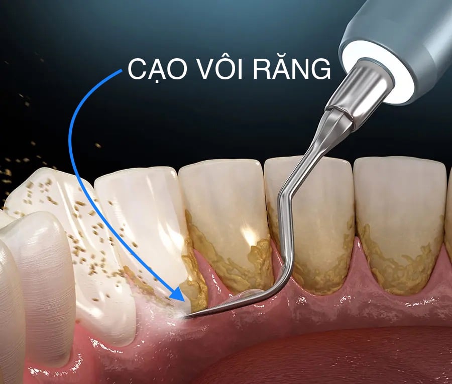 Cạo vôi răng là gì? Bí quyết giữ gìn sức khỏe răng miệng hiệu quả