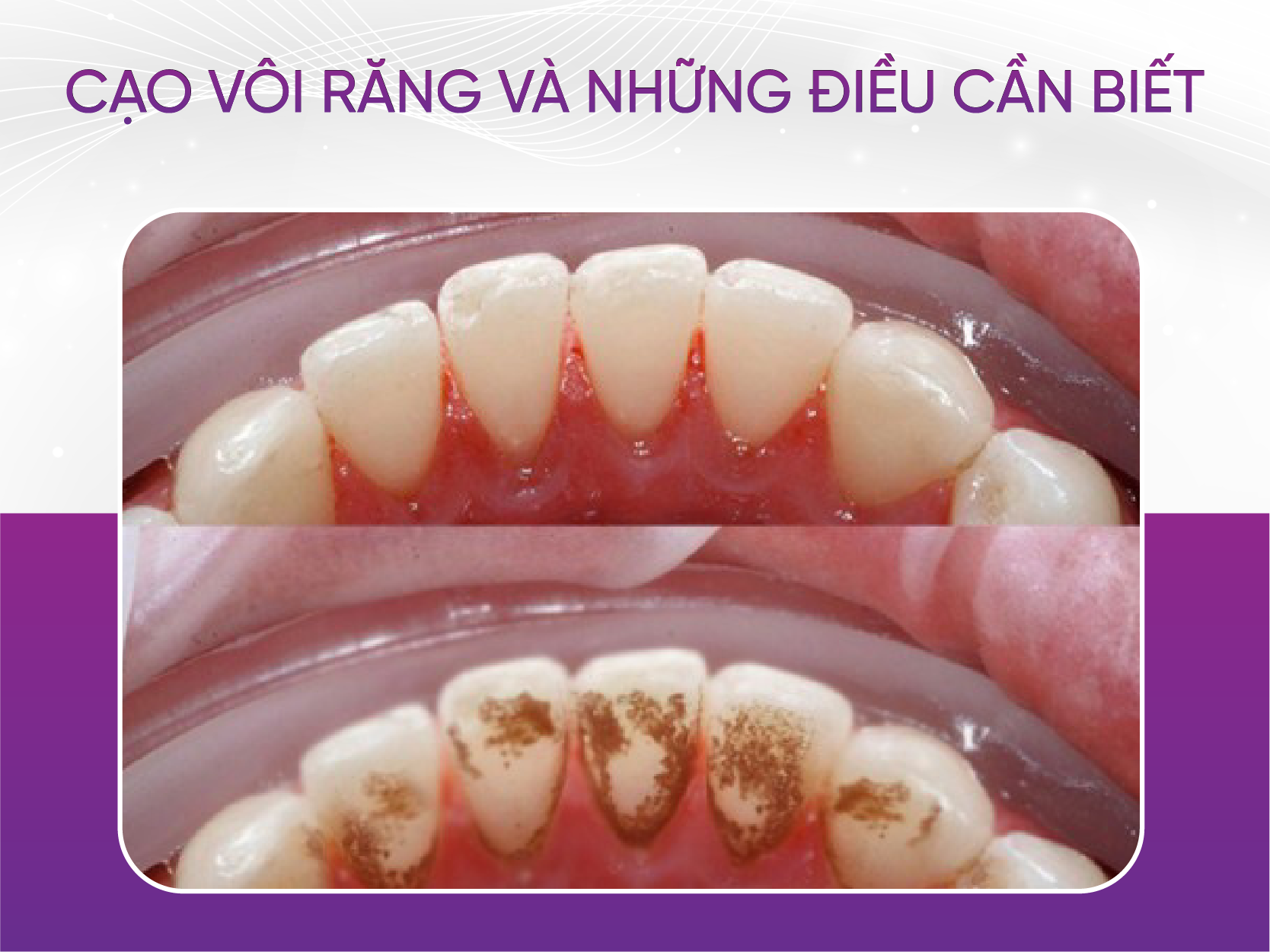 Cạo vôi răng là gì? Bí quyết giữ gìn sức khỏe răng miệng hiệu quả