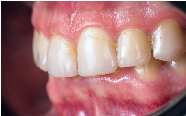 Nướu là gì - Gương mặt của sức khỏe răng miệng và những điều bạn chưa biết