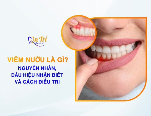 Nướu là gì - Gương mặt của sức khỏe răng miệng và những điều bạn chưa biết