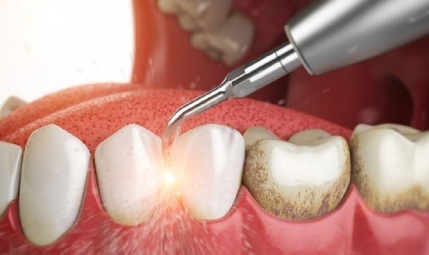 Tác hại của việc lấy cao răng - Đừng xem nhẹ nguy cơ gây hại cho sức khỏe răng miệng