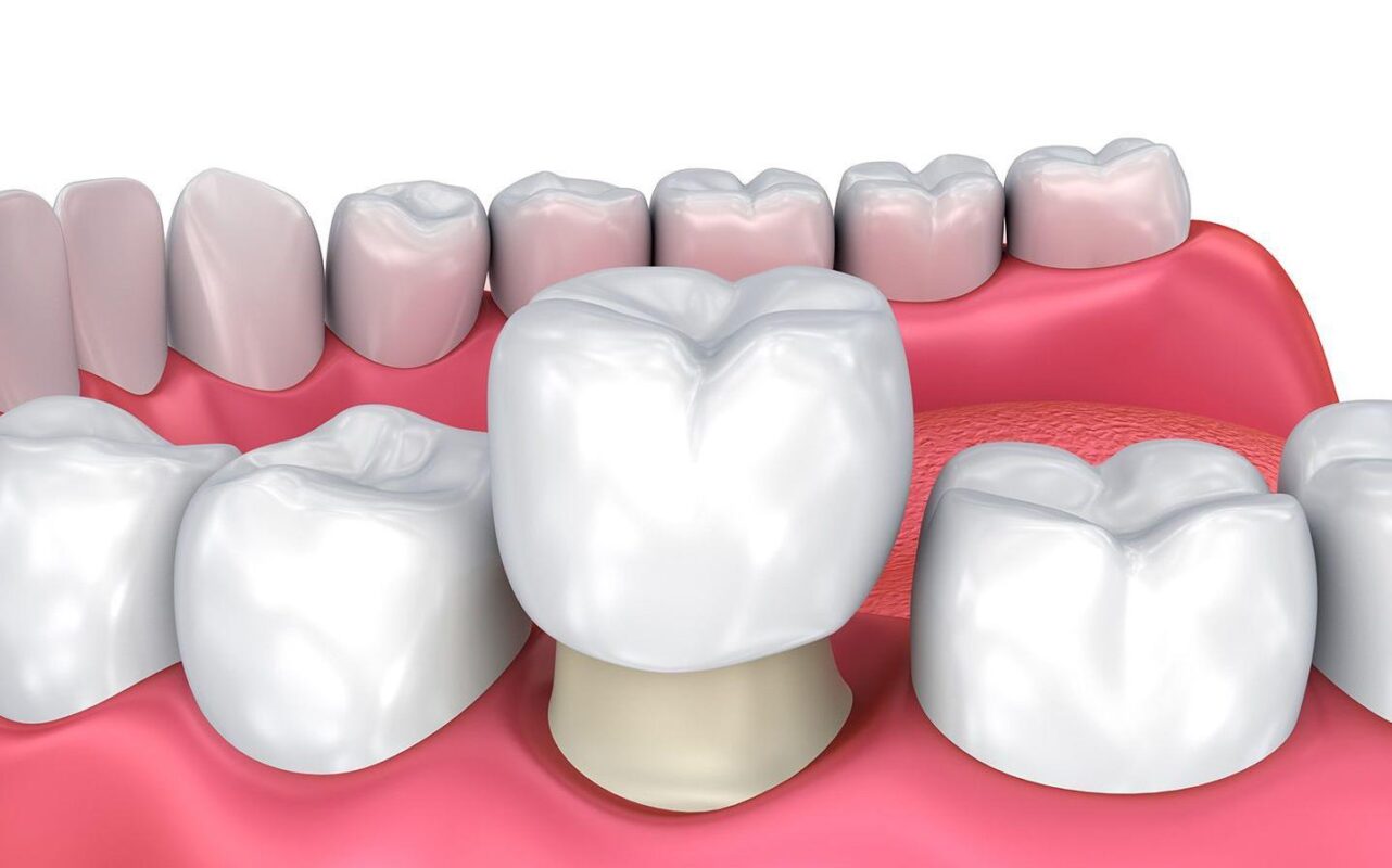 bọc răng sứ cho răng sâu