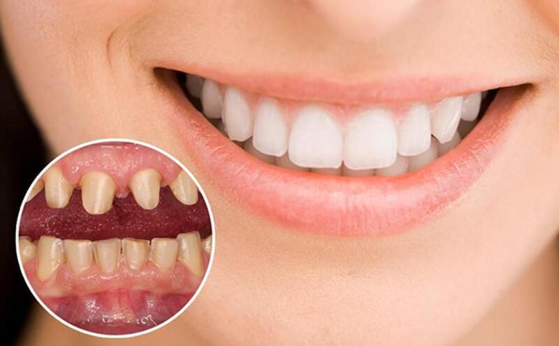 Bọc răng toàn sứ có độ thẩm mỹ cao, an toàn, tuổi thọ lâu dài