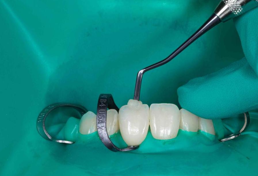 Sử dụng đế cao su bảo vệ răng