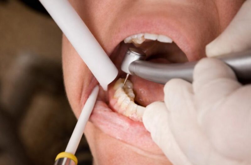 lấy tủy răng có đau không