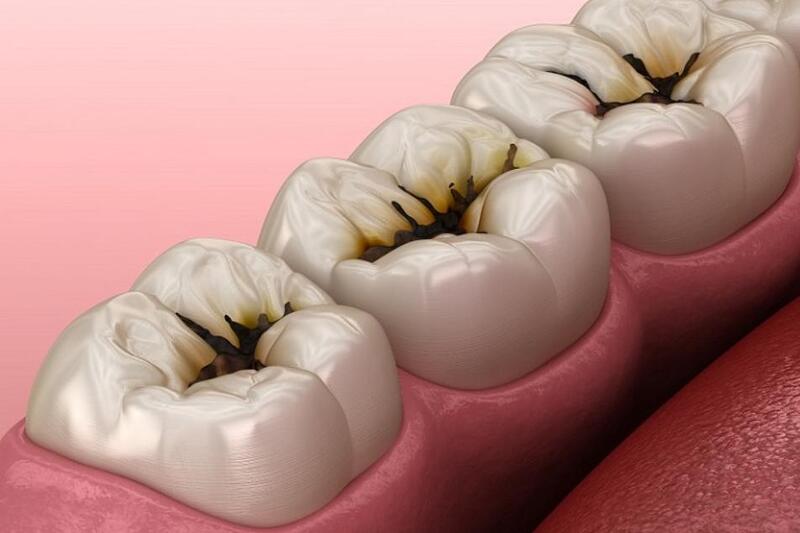 Răng sâu, sứt, mẻ, đổi màu cần trám răng để bảo vệ sức khỏe răng miệng.