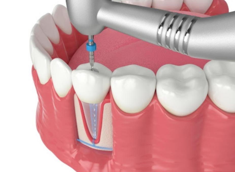 Kỹ thuật y khoa ngày càng hiện đại, lấy tủy răng không còn cảm giác đau đớn