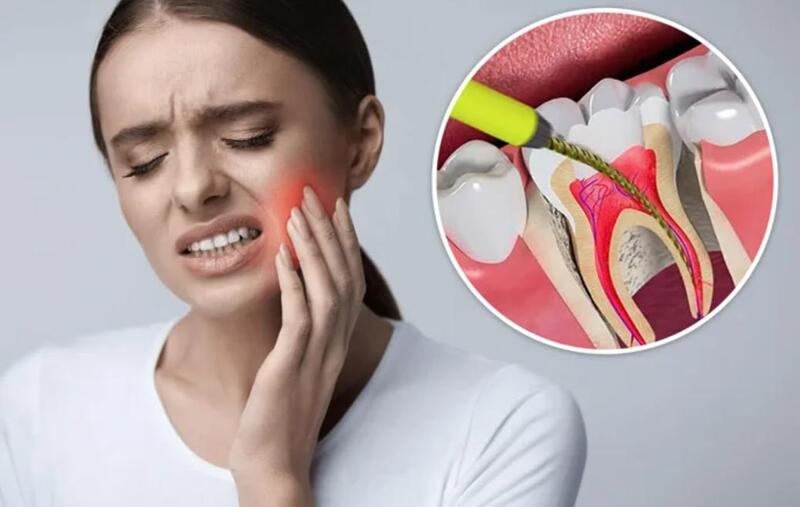Nguyên nhân có thể do chưa lấy sạch tủy, trám răng không đúng kỹ thuật