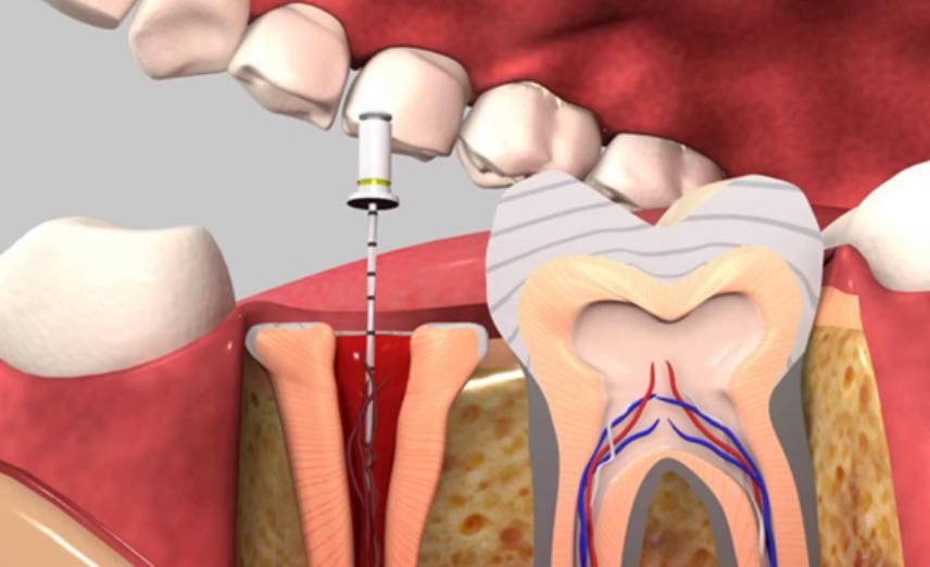 Thực hiện lấy tủy