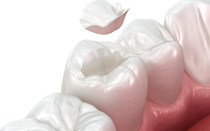 Trám răng composite có độ bền từ 3-7 năm.