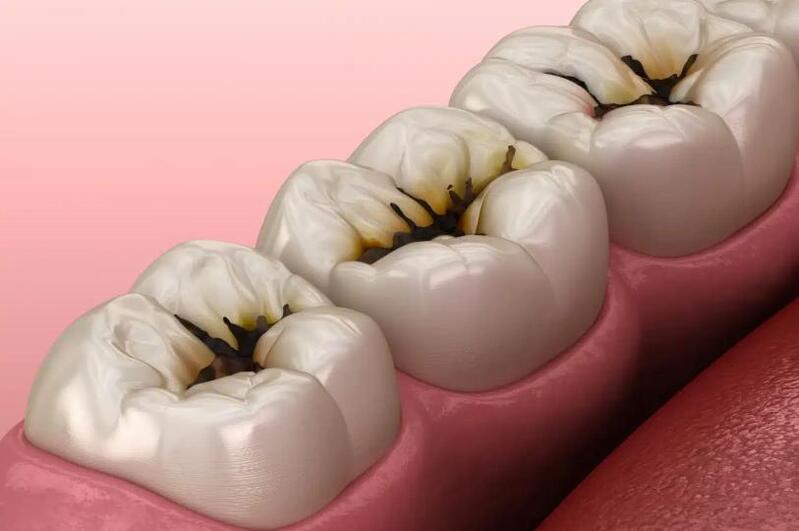 Trám răng không sạch hết mô sâu