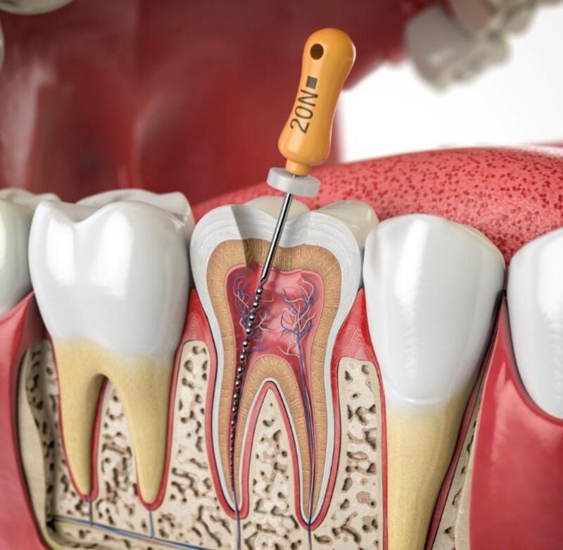 trám răng lấy tủy có đau không
