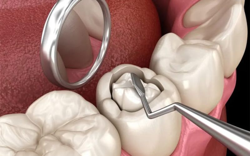 Trám răng rồi có bị sâu lại không