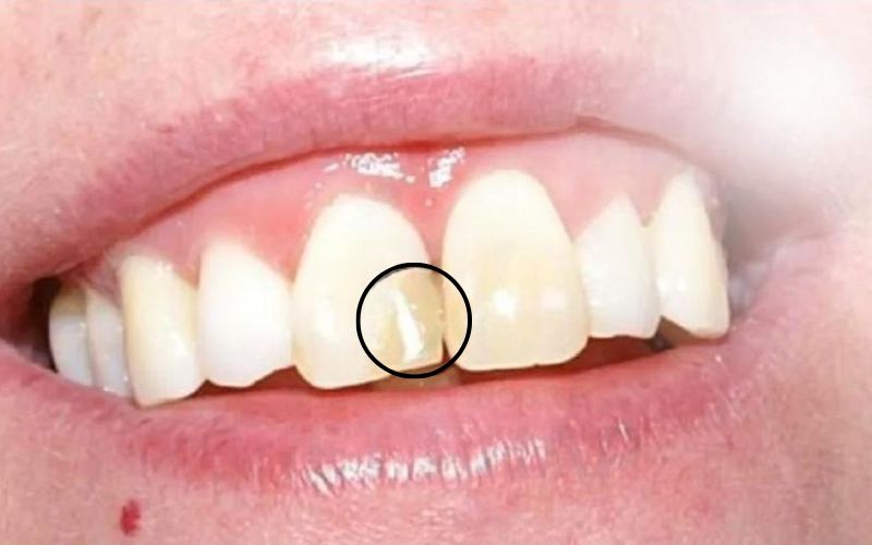 Vật liệu trám chất lượng kém khiến miếng trám đổi màu