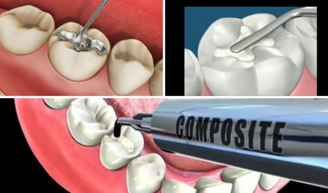 Các trường hợp nên thực hiện trám răng composite
